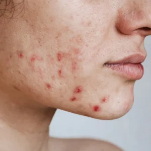 Acne / Breakouts