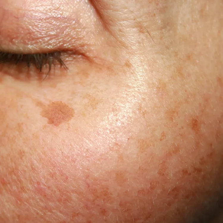 Pigmentation