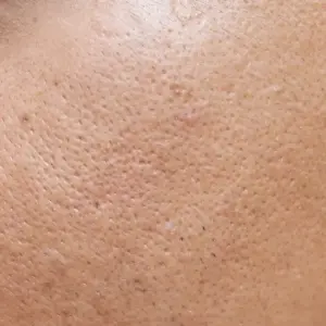 Pores