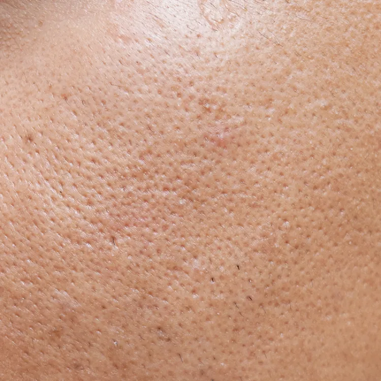 Pores