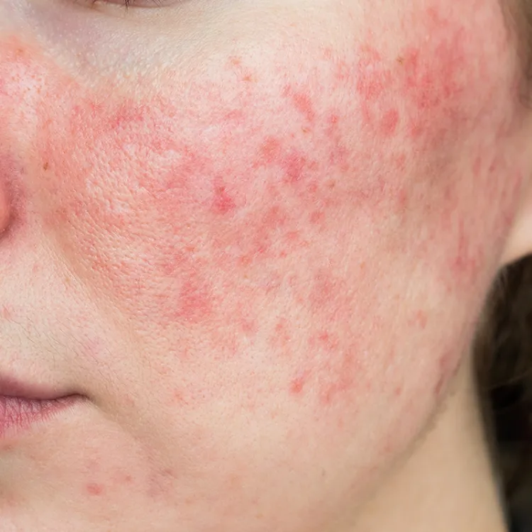 Redness / Rosacea