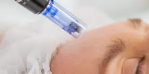 microneedling