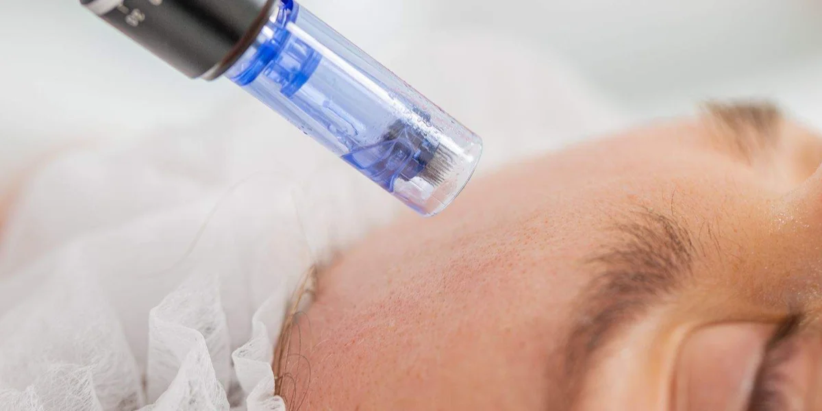 microneedling