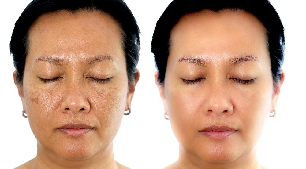 dark spots removal comparison